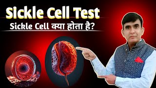 Sickle Cell Test Procedure  Blood Test  pathology Practical [upl. by Oicnecserc]