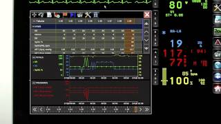 XPREZZON patient monitoring and connectivity I Spacelabs Healthcare [upl. by Ferdinand910]