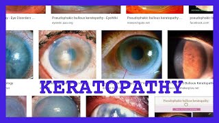 keratopathy [upl. by Romina]