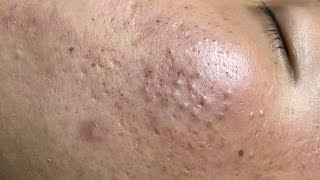 ACNE TREATMENT VU QUYNH MI  Perennial Blackheads On Boy Face 2024FULL [upl. by Araed]