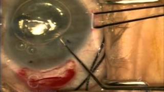 DSEK push in insertion w 30g needle [upl. by Leumek]