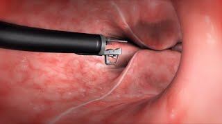 What Happens During the Endoscopic Sleeve Gastroplasty ESG Procedure [upl. by Airel604]