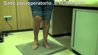 SECUELAS DE CIRUGIA PERCUTANEA DE HALLUX VALGUS mov [upl. by Hjerpe]