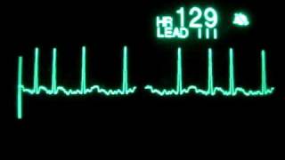 Atrial Fibrillation with RVR [upl. by Odraboel]