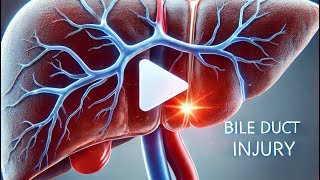 “Master Bile Duct Injury Classifications Strasberg vs Bismuth Explained” [upl. by Brennan488]