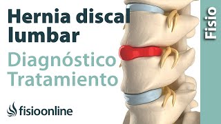 Hernia discal lumbar  Diagnóstico consejos ejercicios y tratamiento de fisioterapia [upl. by Humble]