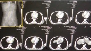 How to do Ct scan of abdomen part 1 [upl. by Valenka]