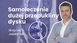 Samoleczenie dużej przepukliny dysku  6 Radiologia kręgosłupa [upl. by Anitsihc703]