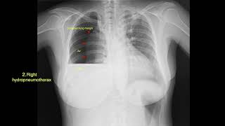 XRay Case 2  Right Hydropneumothorax [upl. by Reggi]