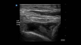 Ankle Ultrasound Joint Effusion Long Axis [upl. by Streetman]