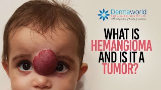 What is hemangioma and is it a tumor  All you need to know  Dr Rohit Batra Explains [upl. by Christopher]