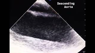 Which one is aorta in dissection to drahmadmirdamadisiXSy18xPgyiZ4mObV [upl. by Standice]