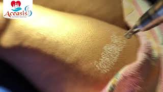 Laser Treatment on Hyper Pigmentation Patches on Legs  Aceasis Aesthetic Solution  9674257567 [upl. by Yllut]