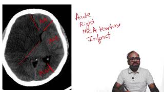 SPOTTERZ  03  Brain hypodensity in a typical vascular territory [upl. by Farant832]