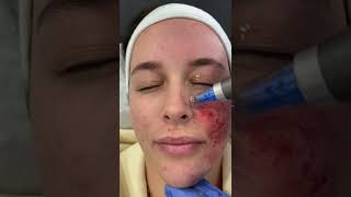 Microneedling with Dermapen 4 at DRMEDISPA [upl. by Otrebireh]