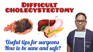 Cholecystectomy being safe and sanetips for surgeonsbest Laparoscopic surgery [upl. by Rolph]