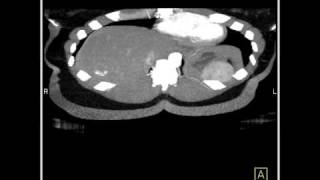 Abdomen Liver Hemangioma of the Liver4 of 8 [upl. by Elora]