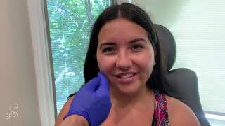 Buccal Fat Removal Surgery  3 Weeks Before amp After Results  by Dr Philip Solomon [upl. by Sezen]