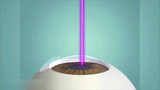 Lasik et PresbyLasik  Opération laser des yeux  Myopie astigmatisme hypermétropie et presbytie [upl. by Adlihtam]