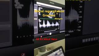 Mitral Regurgitation measure echocardiography treanding shorts [upl. by Hance]