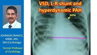 VSD LR shunt and hyperdynamic PAH [upl. by Benson]