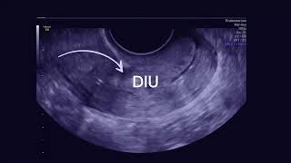 Dispositivo intrauterino DIU en canal cervical [upl. by Omlesna]