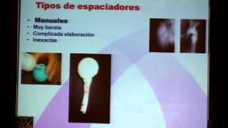 USO DE ESPACIADORES EN CADERA INFECTADA EVERTH MERIDA dvd40 3 [upl. by Gnouv]