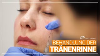 Behandlung der Tränenrinne  M1 Med Beauty [upl. by Bosson]