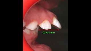 Amazing two phase treatment of Sever Class II Div 1  lama 10Y [upl. by Ruby103]