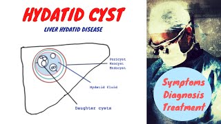 Hydatid Cyst [upl. by Skip858]