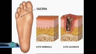 Medicina Facile  Curare il Piede diabetico [upl. by Erbas]