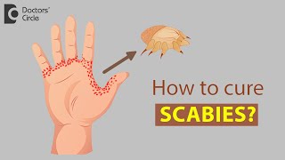 How to cure Scabies  Dr Rajdeep Mysore [upl. by Rochette]