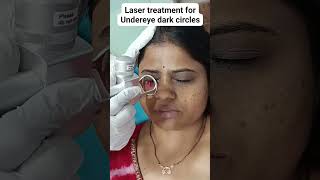 Laser treatment for Undereye dark circles skintreatment [upl. by Nivahb]