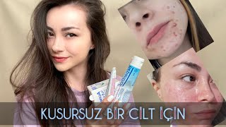 Sivilcelerimden Nasıl Kurtuldum  Roaccutane amp İlaçsız  Acnemix  Sivex Losyon  Acnelyse [upl. by Okechuku862]