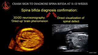 Crash Sign Diagnosis of Spina Bifida at 1113 weeks [upl. by Atnwahs]