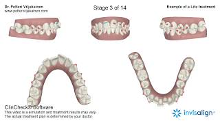 ClinCheck 3D treatment plan of an Invisalign Lite Treatment [upl. by Rocky]