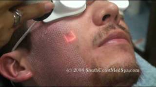 Active FX Laser Acne Scars Removal [upl. by Siana]