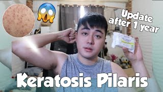 UPDATE SA KERATOSIS PILARIS KO  chicken skin  AFTER 1 YEAR 😳😥 [upl. by Jakie]