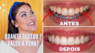 Sorriso NOVO rápido com o aumento de RESINA nos dentes  Quanto CUSTOU TUDO CONTEI PRA VOCÊS [upl. by Sergio286]