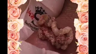 satisfying acne blackhead removal relaxing video5 [upl. by Ellie]