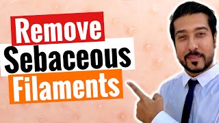 Sebaceous Filaments  3 Steps to Get Rid of Sebaceous Filaments FAST [upl. by Adi]