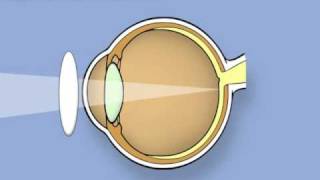 Retinoscopy of the eye Ophthalmology [upl. by Pergrim]