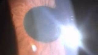 uveitis with hypopyon [upl. by Eatnhoj]