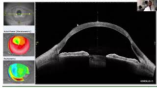 Lecture Keratoconus Worldwide Understanding the Diagnostic amp Therapeutics Alternatives [upl. by Brader7]