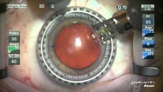 Corneal Relaxing Incisions  NAPA NOMOGRAM [upl. by Nipahc]