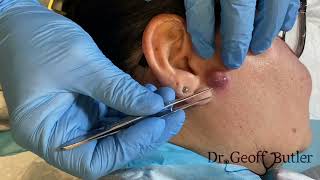 Drainage of an infected cyst in front of the ear [upl. by Ycnay]