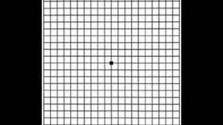 Grid for Macular Degeneration [upl. by Carlotta355]