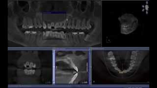 Nasopalatine Duct Cyst  Cone beam computed tomography [upl. by Pauli222]