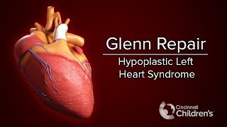 Medical Animation Glenn Operation  Cincinnati Childrens [upl. by Chirlin]