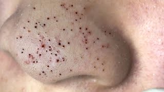 Big Cystic Acne Blackheads Extraction Blackheads amp Milia Whiteheads Removal Pimple Popping  5683 [upl. by Joshua]